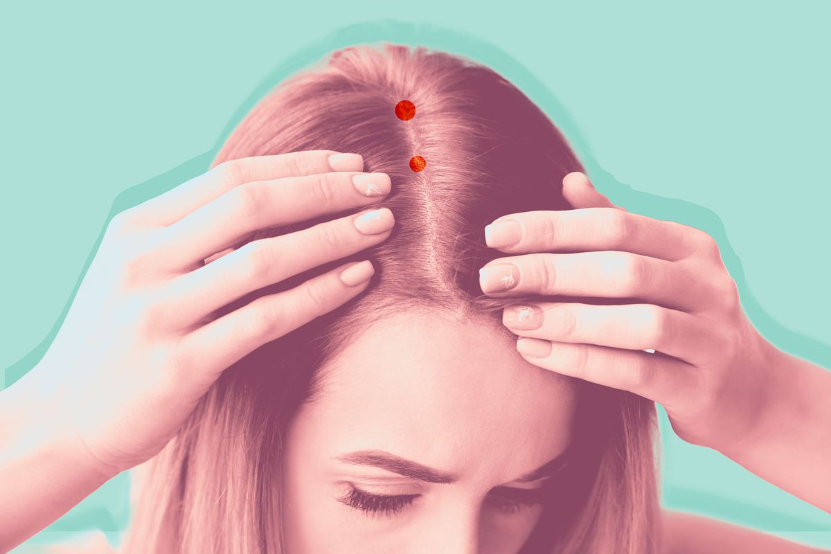 How to get rid of scalp acne