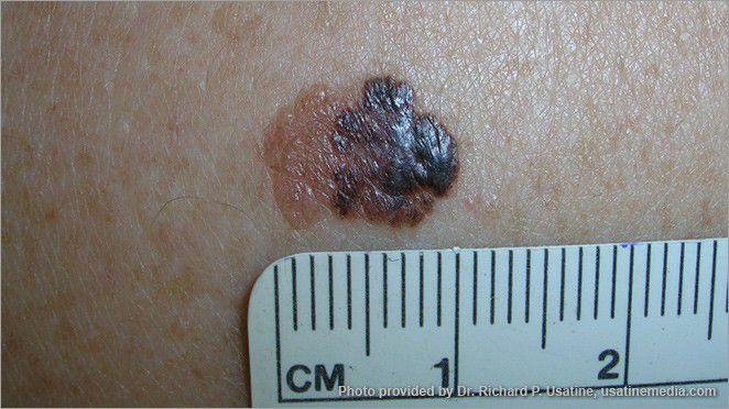 What Does Skin Cancer Look Like? | Shape