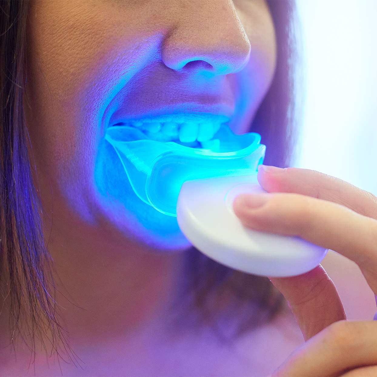 The Best Teeth Whitening Kit for a Brighter, Whiter Smile Shape