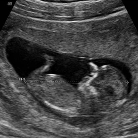 Pictures of pregnancy ultrasound