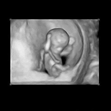 Can You Tell Gender At 11 Weeks 3 Days Week 11 Ultrasound What It Would Look Like Parents