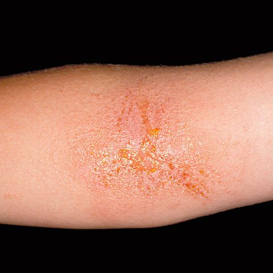 Causes And Cures Of Rashes Parents