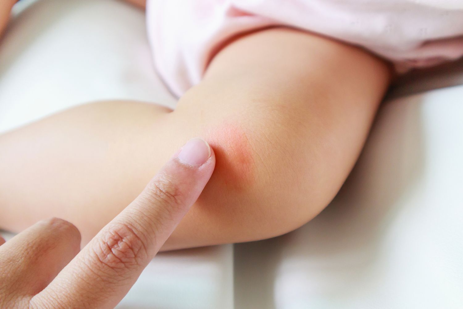 Skin Rash Treatment How To Stop The Itch Parents